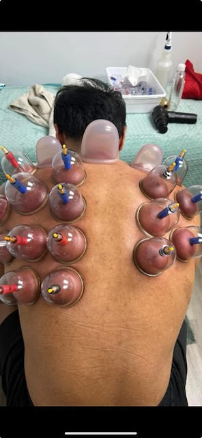 Cupping therapy at Island of Health